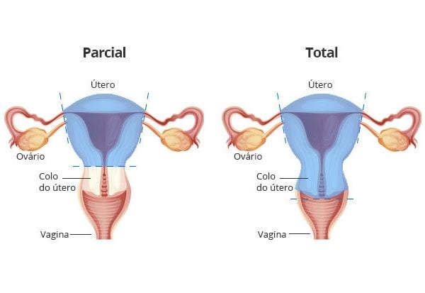 histerectomia-retirada-utero-prazer-sexual
