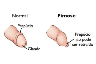 Doença no pênis, Fimose