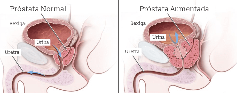 Próstata aumentada